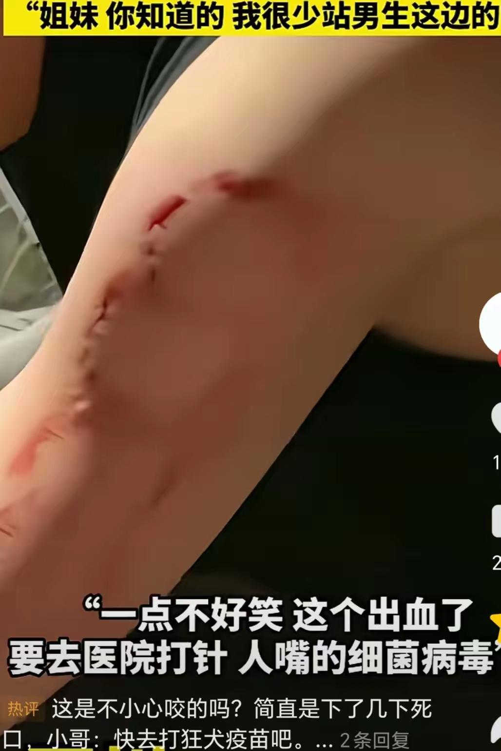 见过情侣吵架的，没见过下手这么狠的！一女孩跟男友起争执，居然对着男友胳膊连咬数口