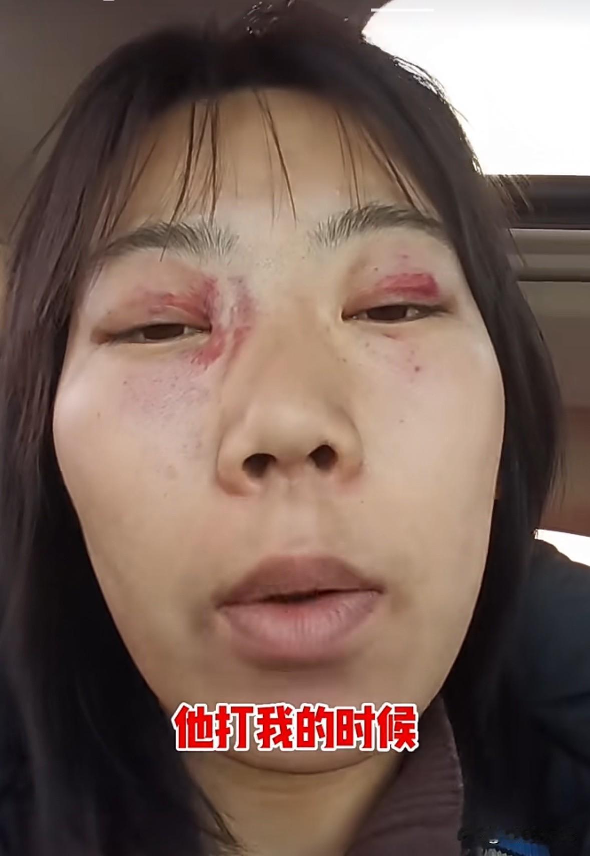 27岁女子被父亲暴打头部几十下，眼睛肿，脑袋疼，头皮也肿，医生说，下手的人是往4