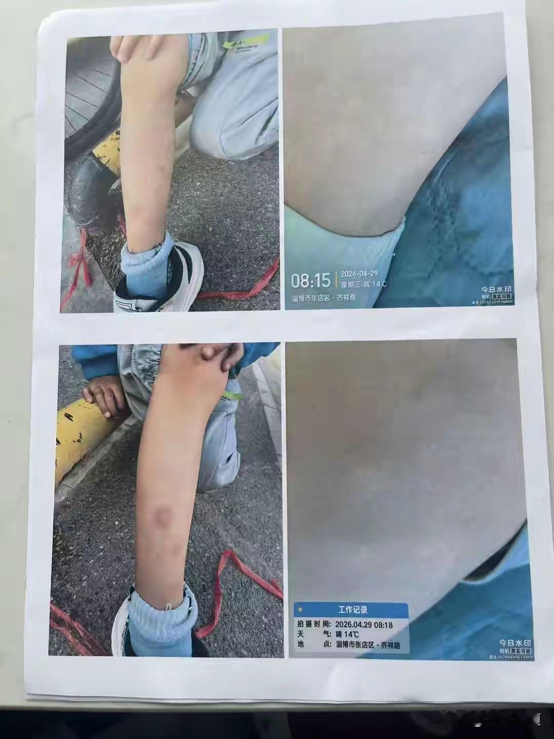 6岁男童在幼儿园被老师“指导”另一名幼儿连踢带踹，拳击13下，身上淤青，家长询问