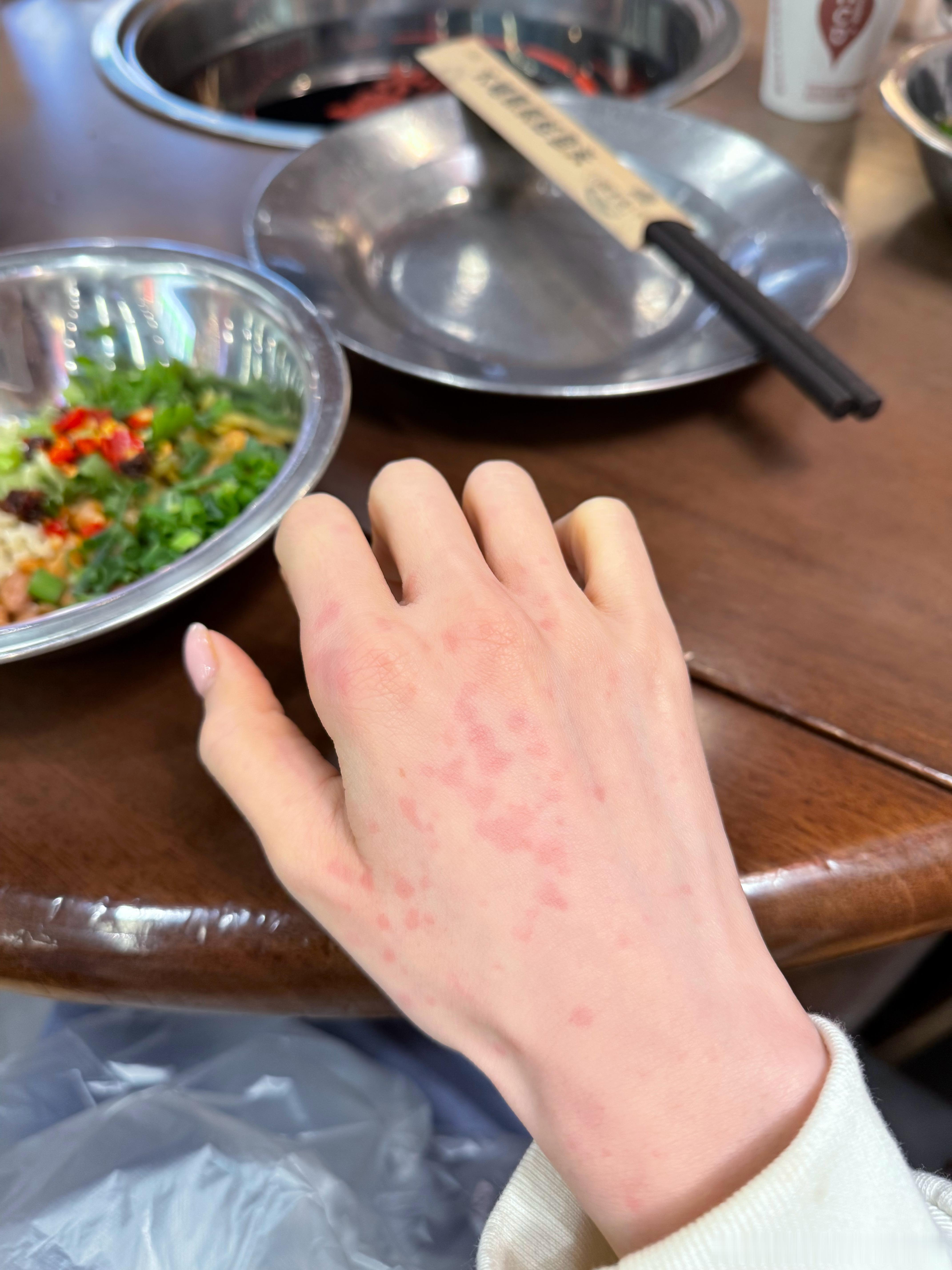 杭州最近气温一直不定！！搞得我换季体质好敏感莫名其妙就这样了 