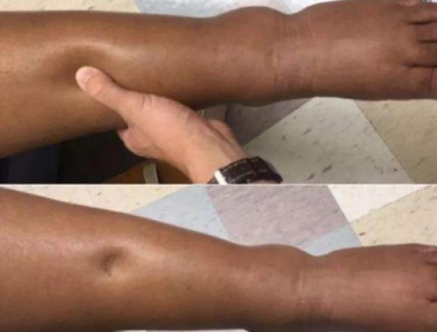 5岁男童小飞在一次小便后，发现尿中起了很多泡沫，赶紧跑去告诉妈妈。然而，妈妈却以