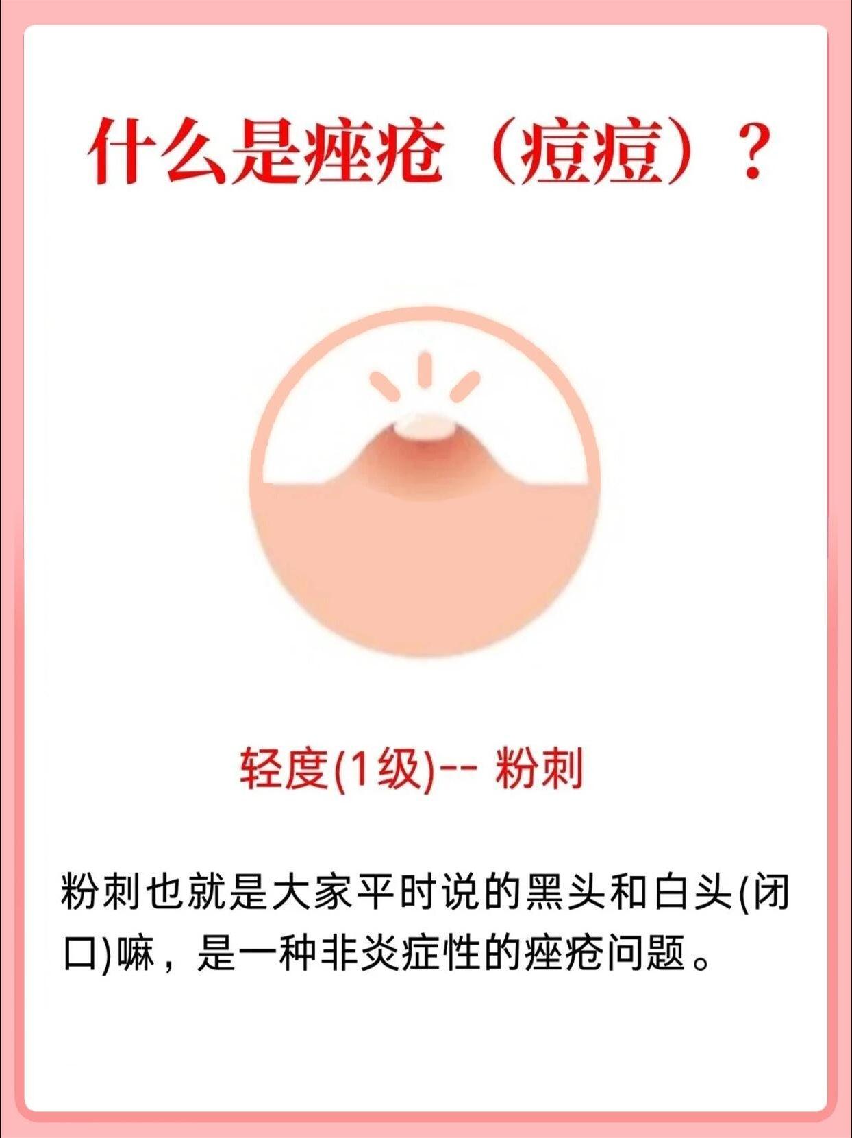 痘痘痤疮分不清?不同等级区分痘痘严重程度。痤疮痘痘肌