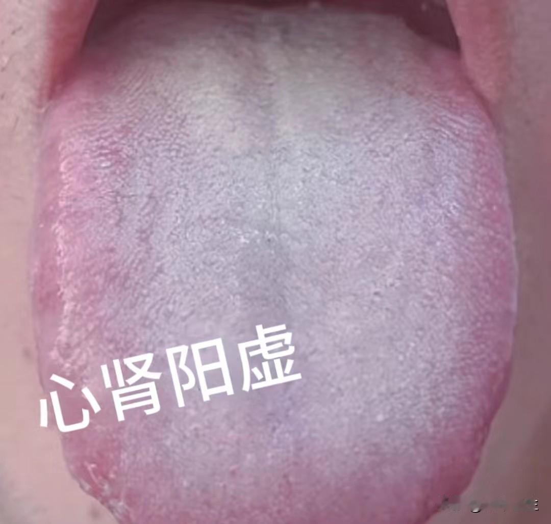 今日舌诊

当出现这样的舌象，就不要只调理心阳虚了。

今天看诊了一位患者，他见