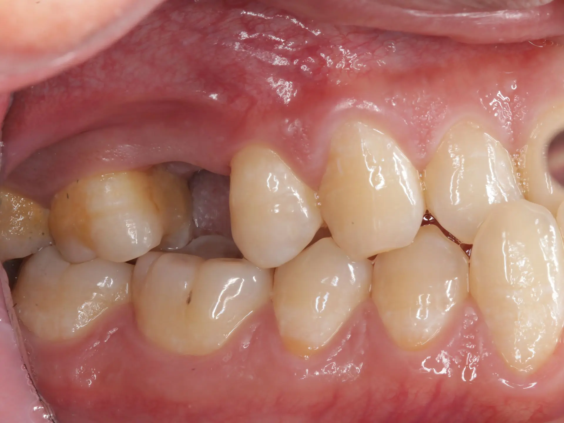 种一颗牙需要多长时间？种植过程分为三个阶段: 第一阶段--植入种植体...