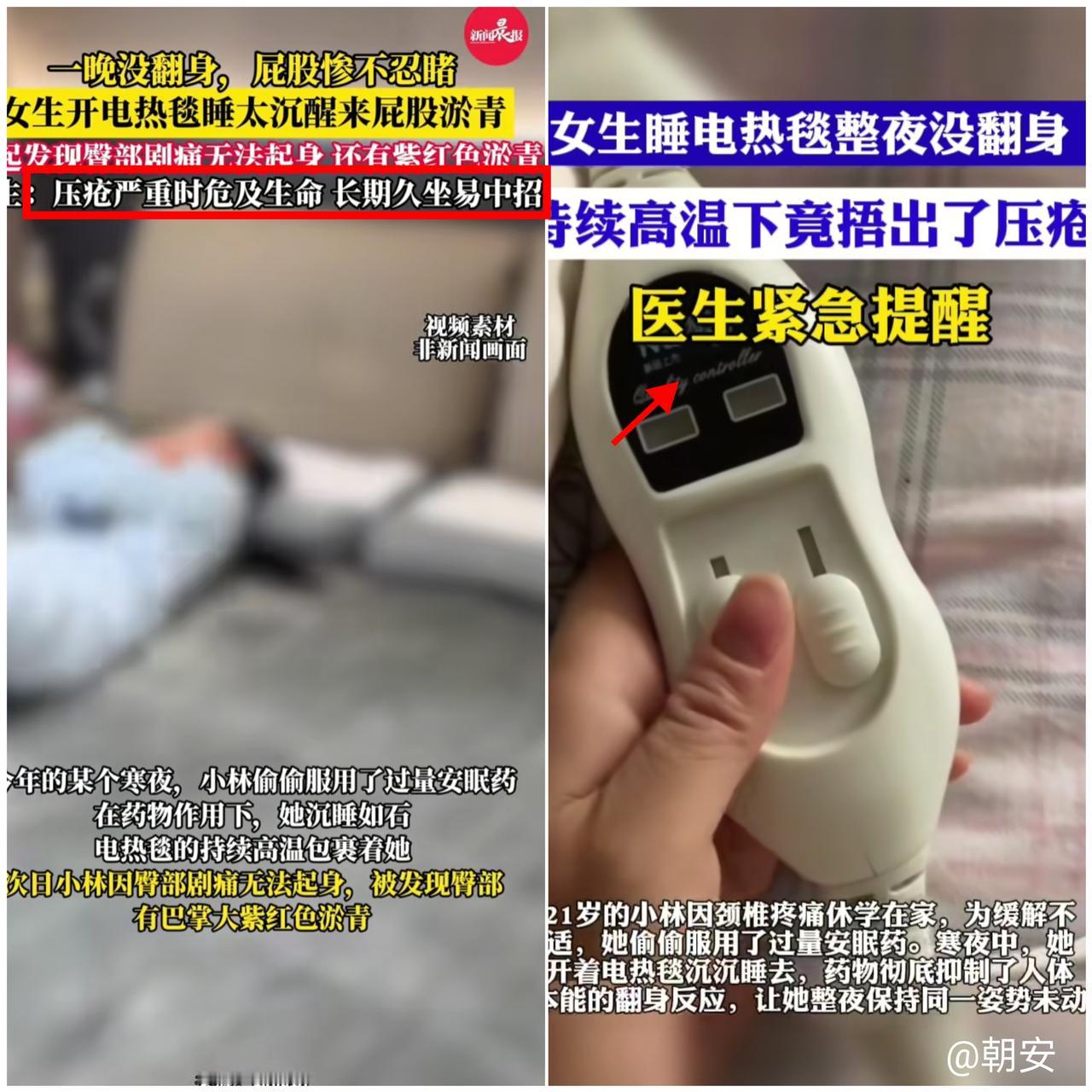 万万没想到！

21岁姑娘睡一觉竟要手术，压疮真不是老人的“专属病”！
 
浙江