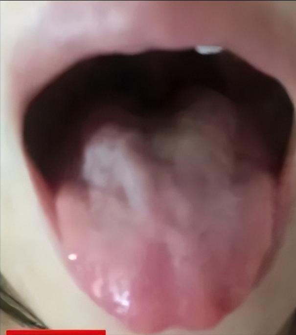 舌象诊断
患者：女，28  
病症：睡眠不足，胃胀。容易劳倦乏力，颈背不适，胆囊