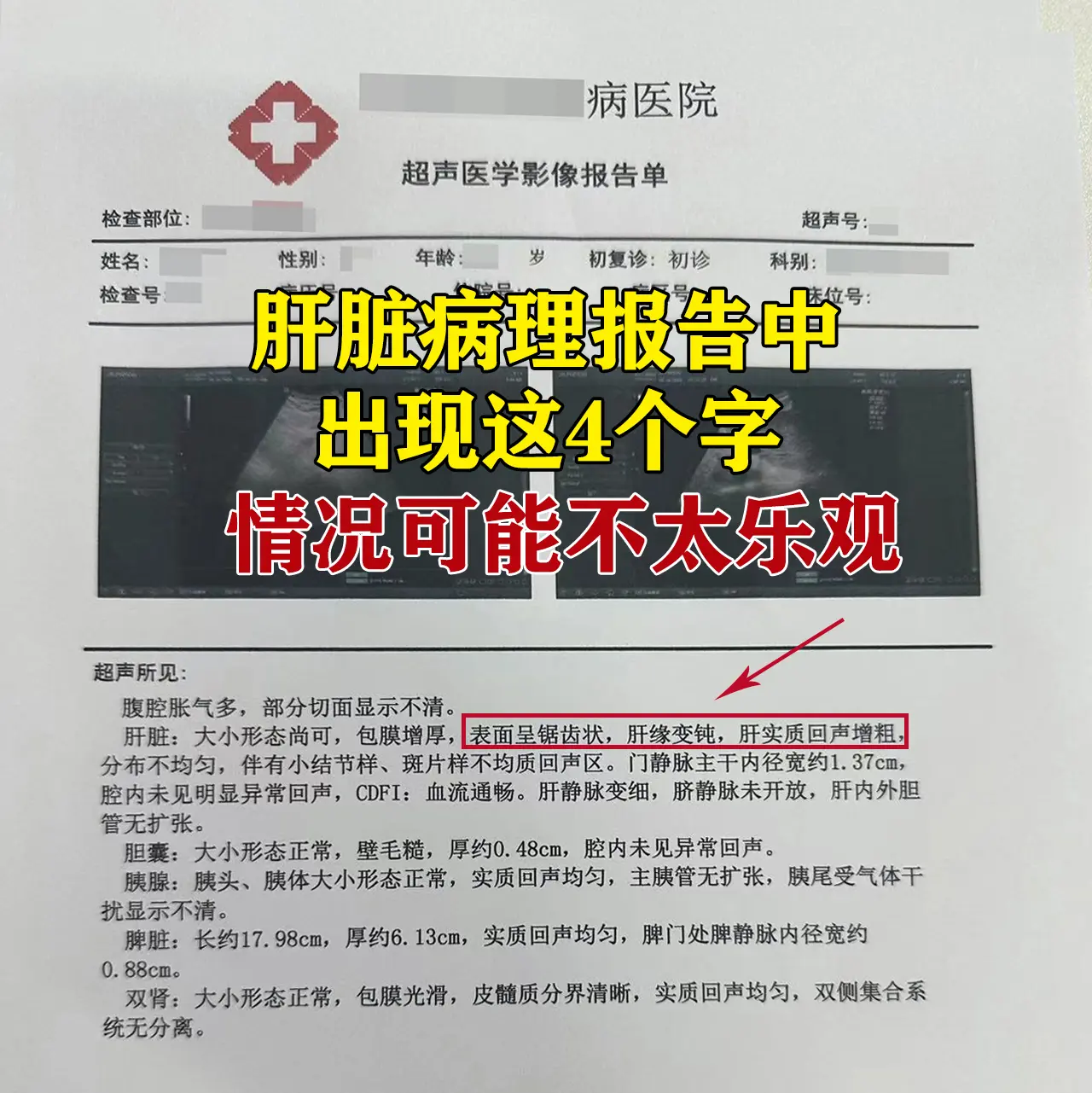 不少肝病朋友做完彩超、CT后，只看最后的结论，常常漏掉报告里暗藏的信号...