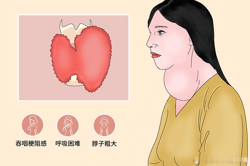 #健康食验计划# 【甲状腺癌给出的6个信号】1、颈部肿块甲状腺癌早期不会有明显的