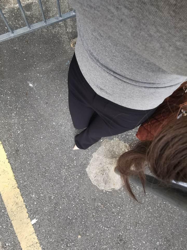医生说 你不要怕疼要用力走啊 不然以后就会一瘸一瘸的