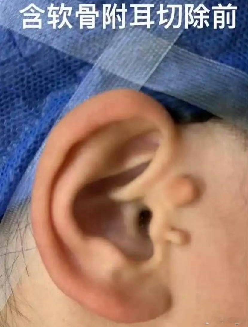 你们见过6️⃣個耳朵的人吗❓我小学🏫同桌——陈浩就🈶六个耳朵、👂👂👂?