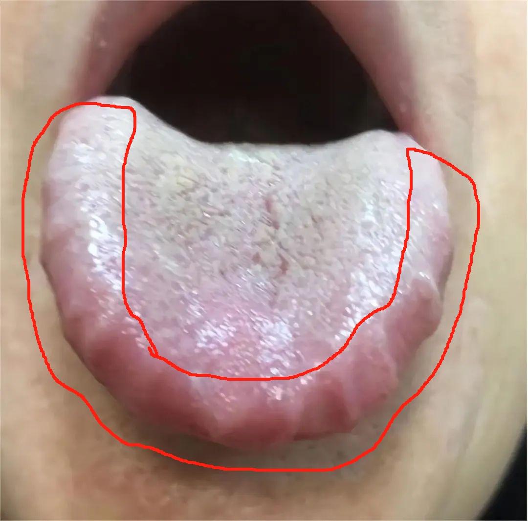碰见这种舌象，病根不在脾胃，男科功能就特差了
舌两侧一圈齿痕，鼓胀发红，舌苔焦黄