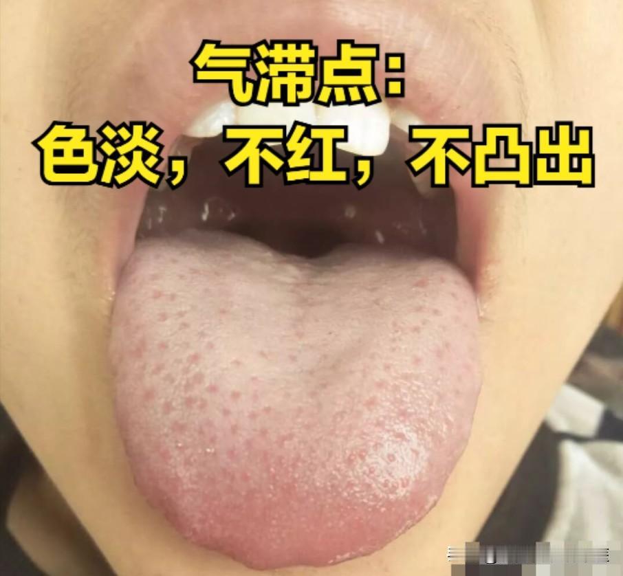 肝郁由轻到重的四个阶段，中医教你看舌来判断

第一阶段：肝气郁结
舌象：舌面有浅