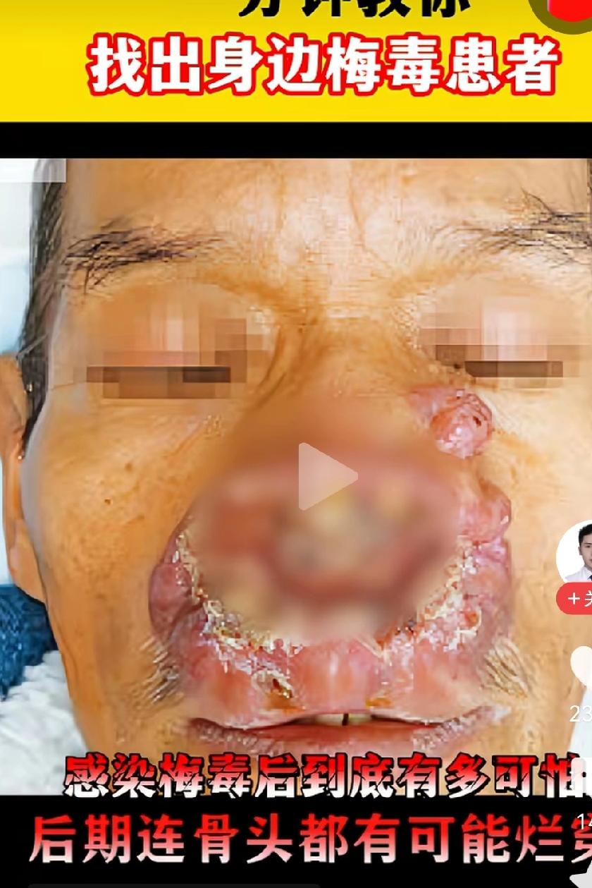 “牢A”，你还没说这一方面。

大约100人里就有1个艾滋病病人。
总数的一半，