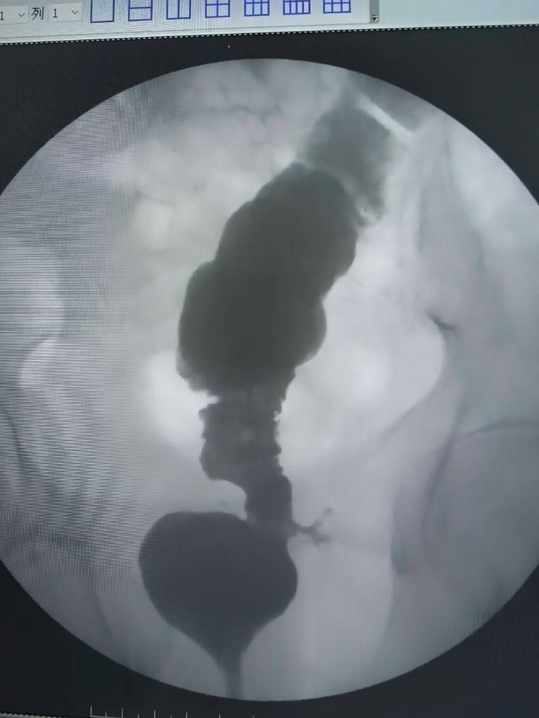 直肠癌术后吻合口狭窄（难治型）球囊扩张术。上午一台直肠癌术后吻合口狭窄...