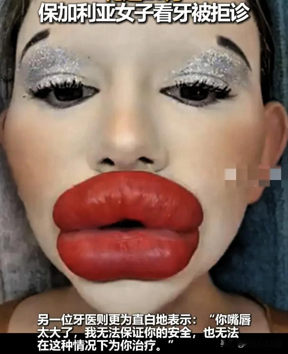 保加利亚一女子为整出“全球最大嘴唇”，花了快20万。结果去看牙时，被牙科医生拒诊