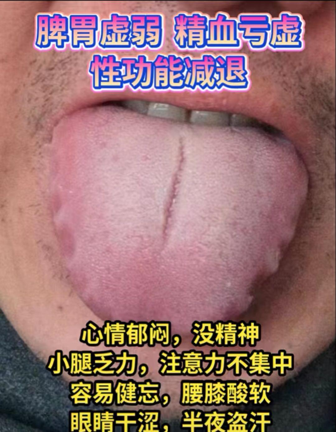 什么是脾虚 教你舌诊看脾气虚