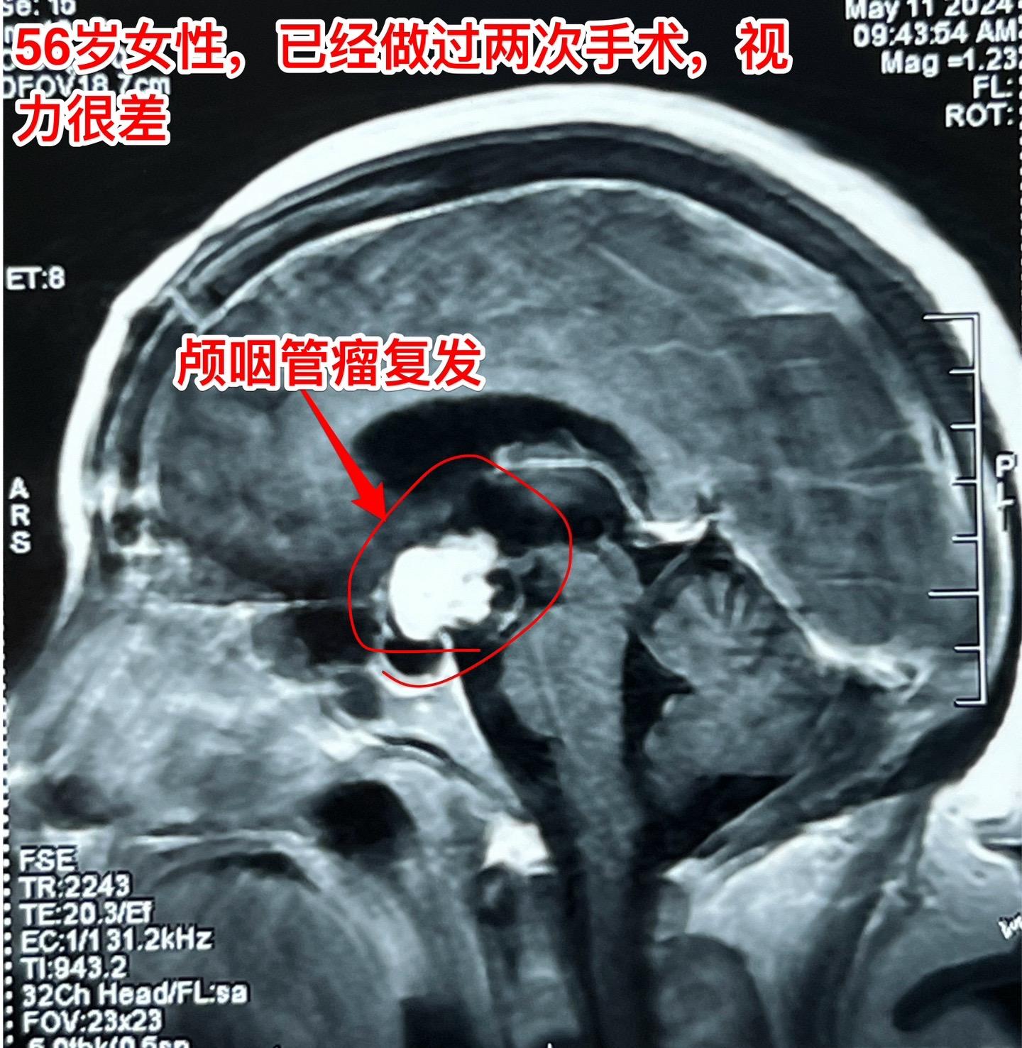 5月17日两例颅咽管瘤手术。第一例患者56岁，双眼视力都很差了，之前做过两次开颅手术，为乳头型颅咽管瘤复发。
第二例患者，24岁男性，因视力下降发现颅咽管瘤，也是乳头型颅咽管瘤。
两例患者手术入路不同，效果都满意，颅咽管瘤均得到完全切除。希望肿瘤不复发。