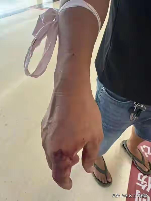 云南临沧一位猛人，驱赶进家里的眼镜蛇，被蛇咬伤手掌，到医院就诊，怕医生不知道是什