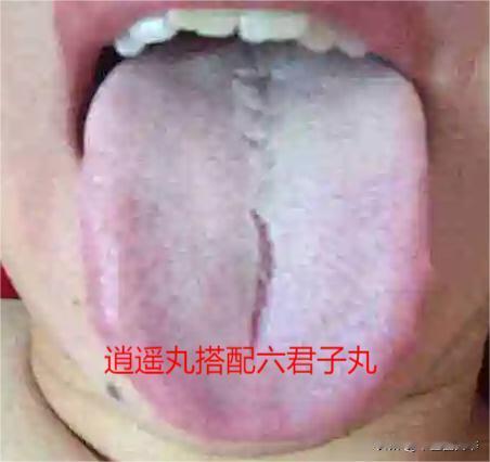 建议每个人都学会逍遥丸，用好了疏肝健脾补肾，还能化一身痰湿
逍遥丸搭配六君子丸
