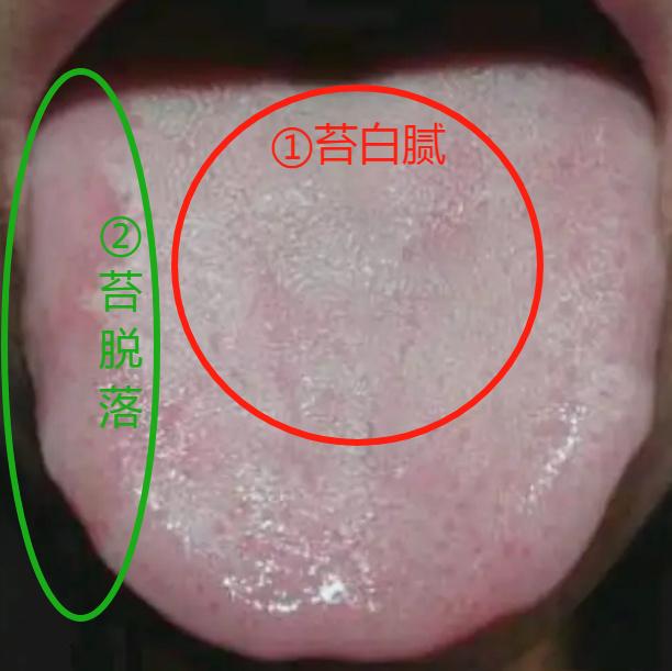 这种舌象，其实讲过很多次，千万不要当做脾虚湿气重来调理，不然只会瞎费功夫！
为什
