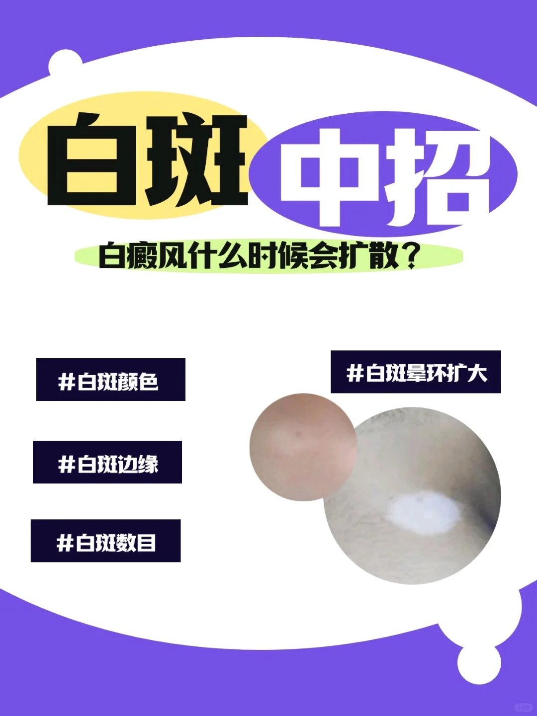 白斑注意‼️白癜风何时会显露扩散现象🔍