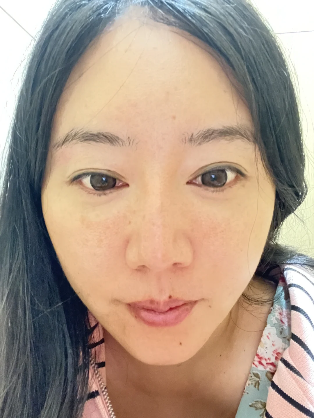 今天来做双眼皮修复了