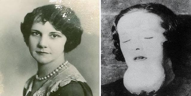 1922年，一名25岁的花季少女因为牙疼去看病，当医生轻轻触碰牙齿时，她的下颚骨