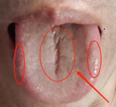 裂纹这么深，还当脾虚治，那你纯粹是在浪费时间！

这个舌头看起来是脾胃出了问题，