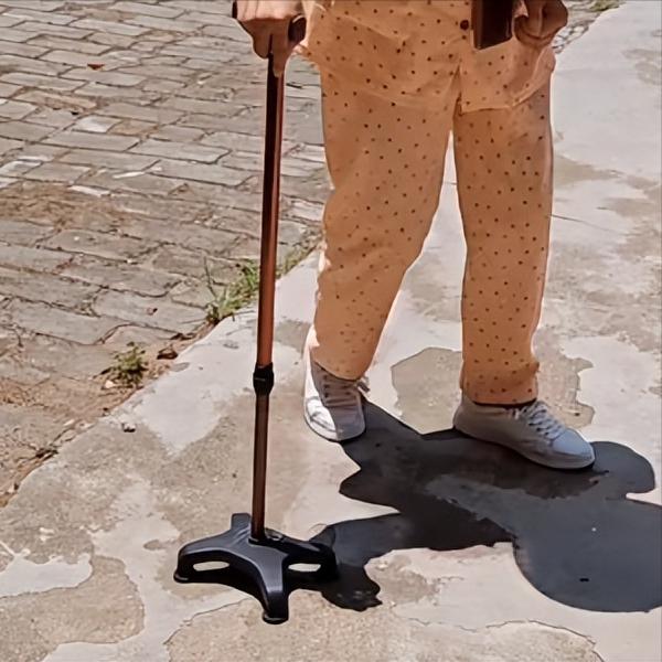 偏瘫最怕出现这两种情况！

第一种情况：肌张力增高
肌张力增高之后你会发现，患侧