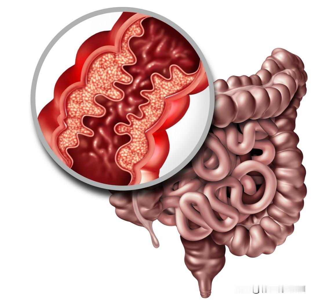 反复腹痛腹泻？5个经典中成药调理慢性肠胃炎，温和护胃不刺激，一文读懂
 
慢性肠
