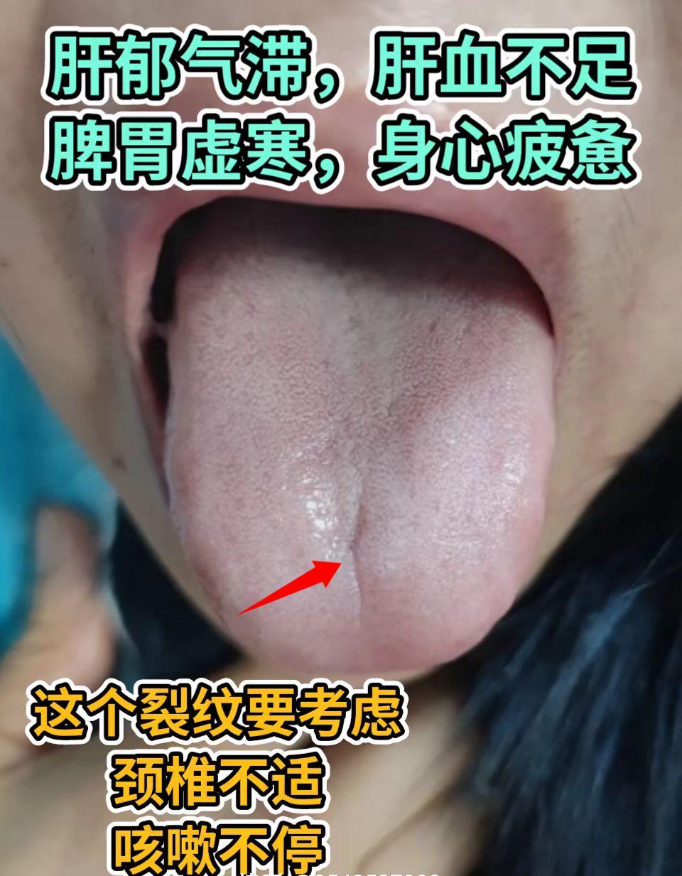 脾胃舌象 进来看看你是那种