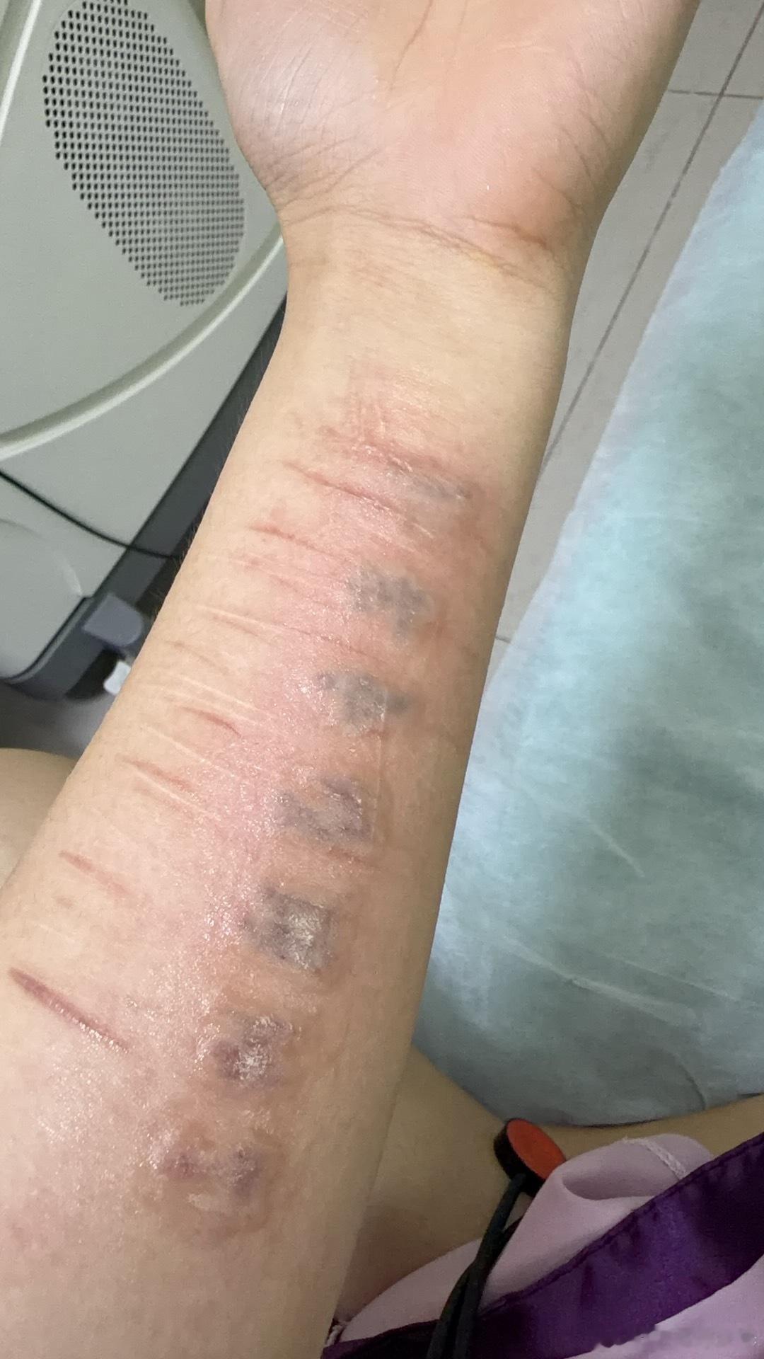 今天来洗纹身了，哎 