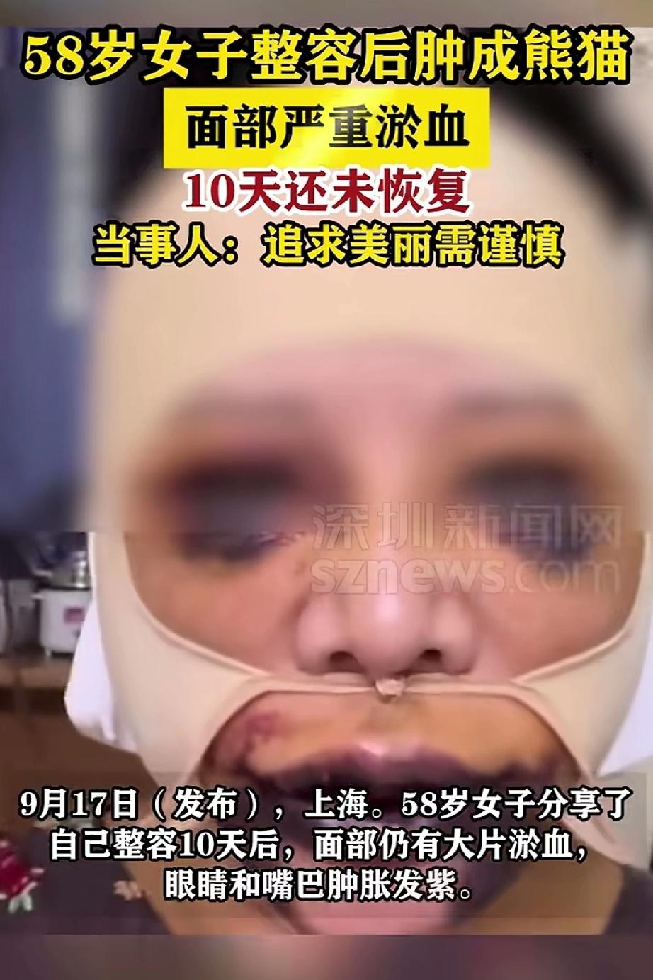 58岁女子整容后肿成“熊猫”
      近日，上海一名58岁女子分享了自己整容