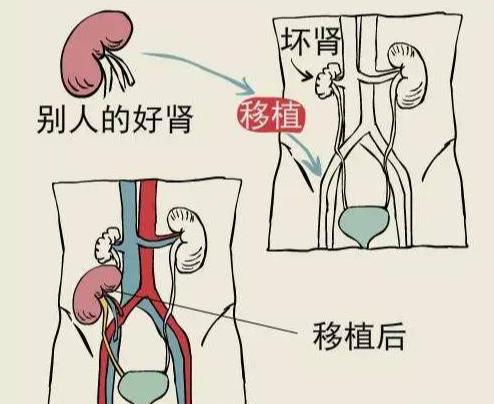民间一直有“噶腰子”的不实传言，本文科普肾源分配全流程，帮助大众辨别谣言。

肾