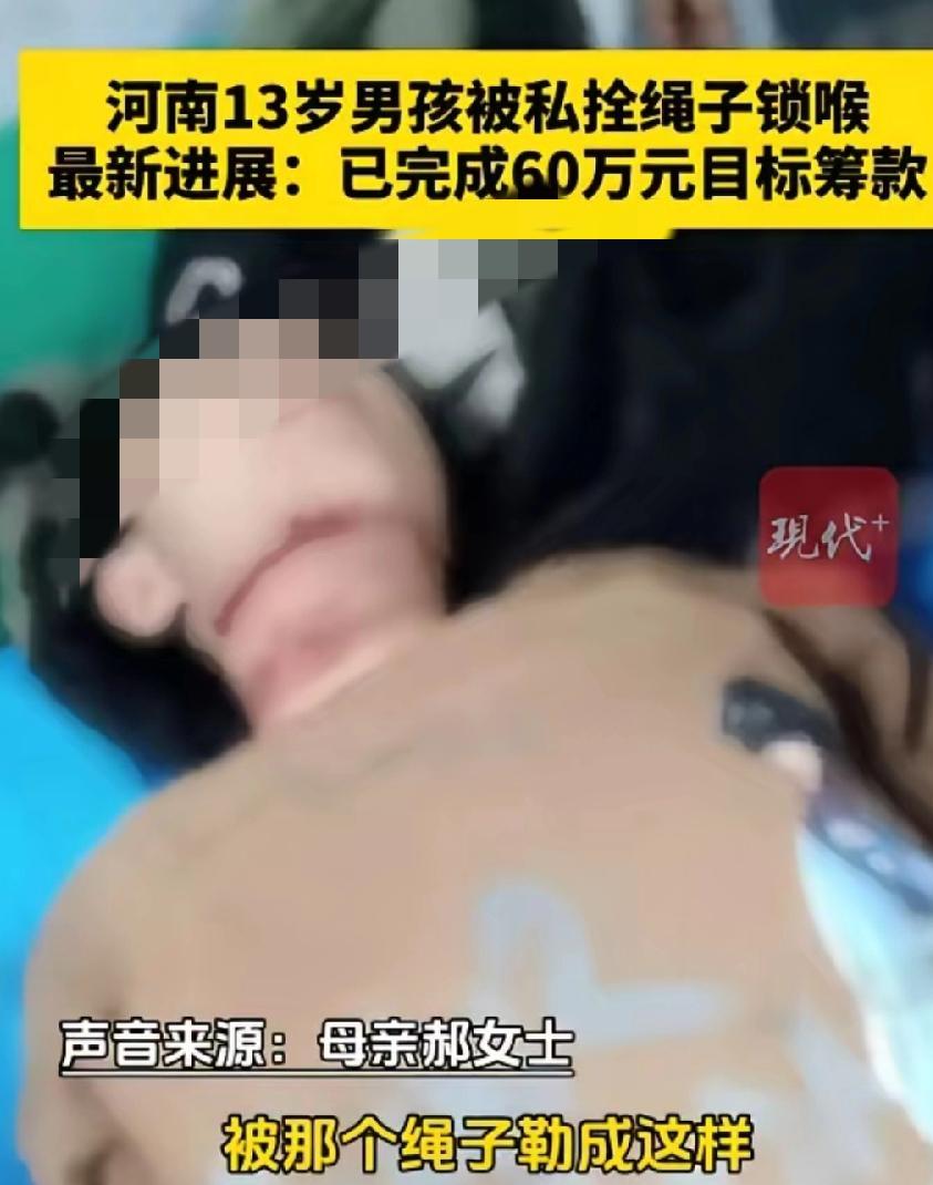 被绳子勒喉咙13岁男生，就医治疗，下巴下面一道很长鲜红勒印，喉结处已被勒得一大片