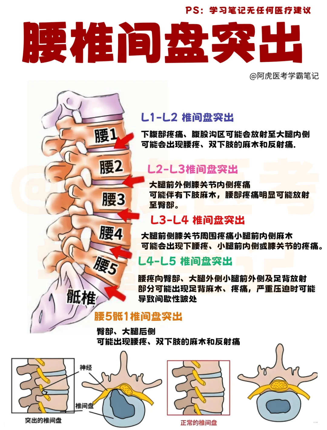 医学生笔记📒｜腰椎间盘突出👆