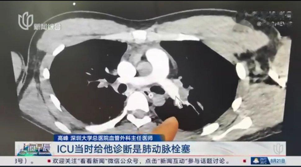 #男子坐5小时高铁险猝死#都应该当回事。划重点：小概率下，久坐飞机、久坐火车、久