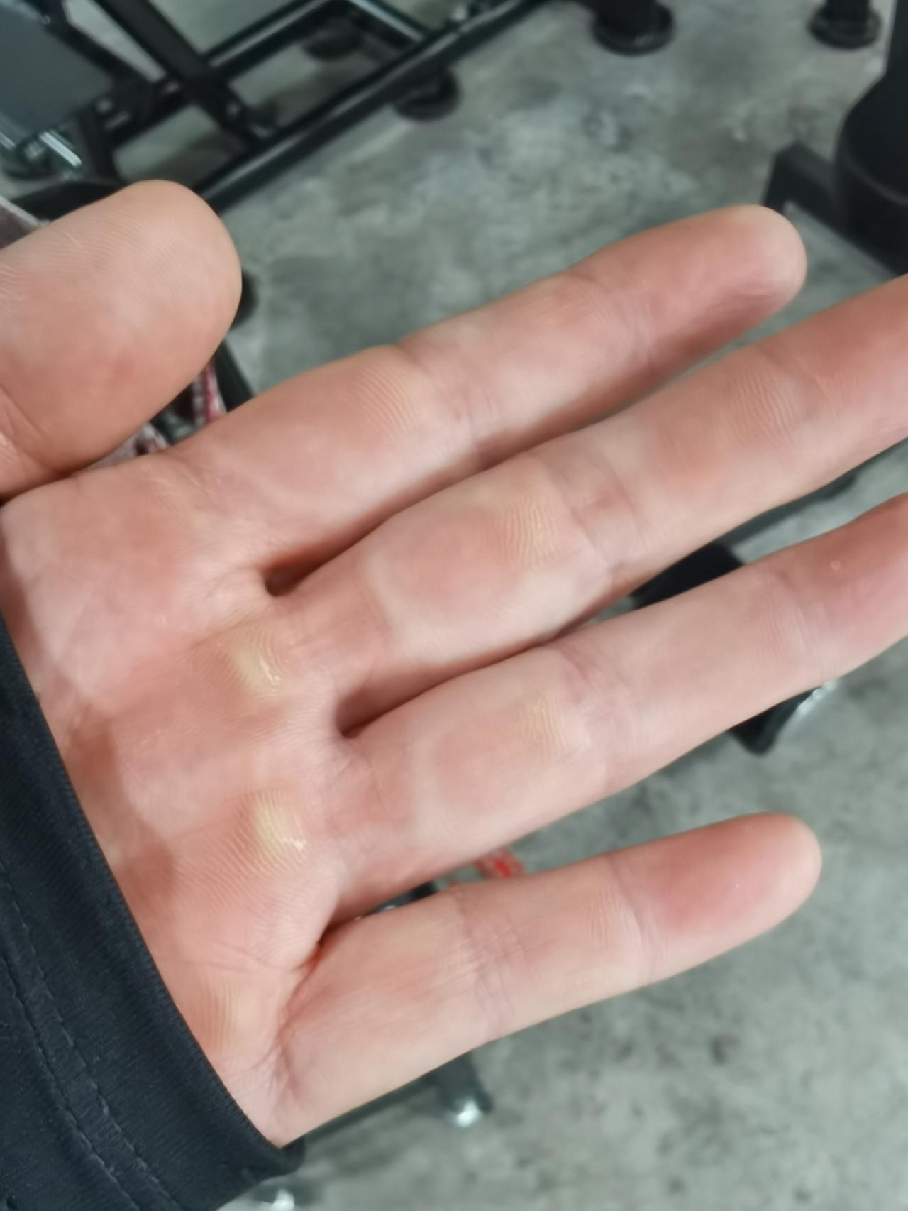 下午在健身房做垂吊，整个人挂在单杠上，手刚握住就觉得有点疼。低头一看，正好是茧子