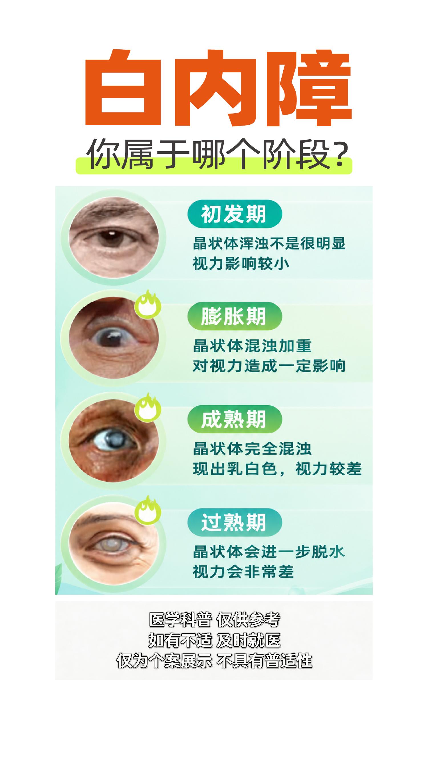 你属于白内障的哪个阶段？。