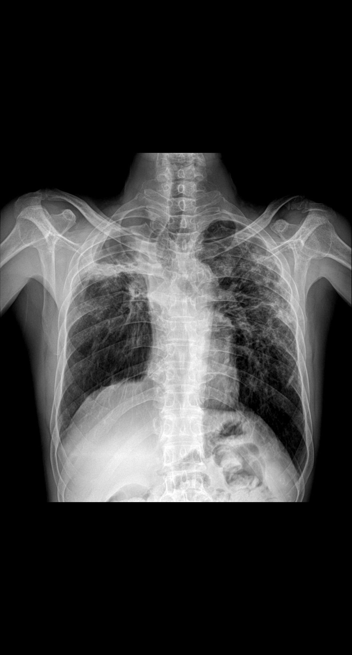 上期被查封 重新发一下家人们 再来一起探讨下肺结核  胸部正位片