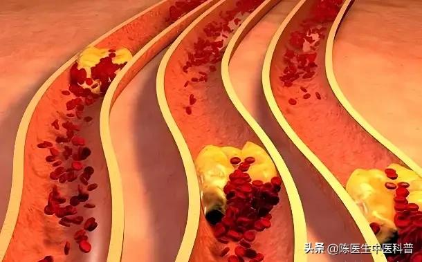 瘀血一消，全身轻松！5种瘀堵信号+对应方案，给气血“通一通”
 
大家好，我是陈