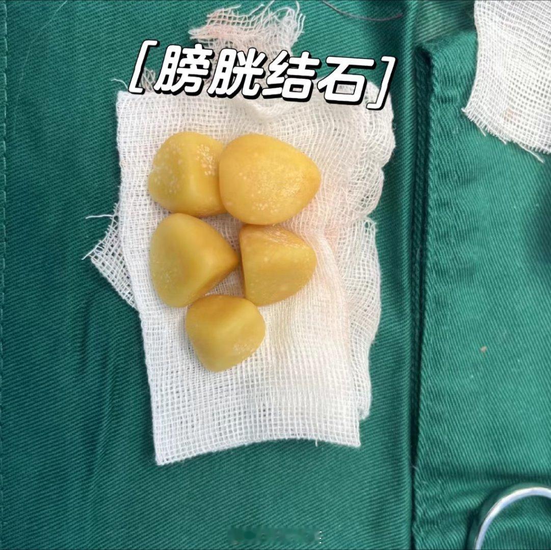 男子膀胱取出2.6斤巨型结石太吓人！男子膀胱取出2.6斤巨型结石近日，广东湛江一