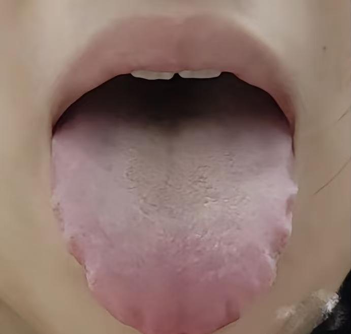 瞧瞧这舌头，水润光滑，同时还伴有心火旺盛的迹象。尽管长时间祛湿，却没有明显的效果