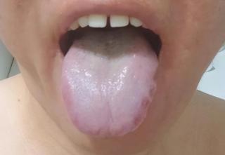 你的舌象正在报警：胖嫩齿痕 + 淡白腻苔，是湿浊困住了脾阳！
看这张舌象：舌体胖
