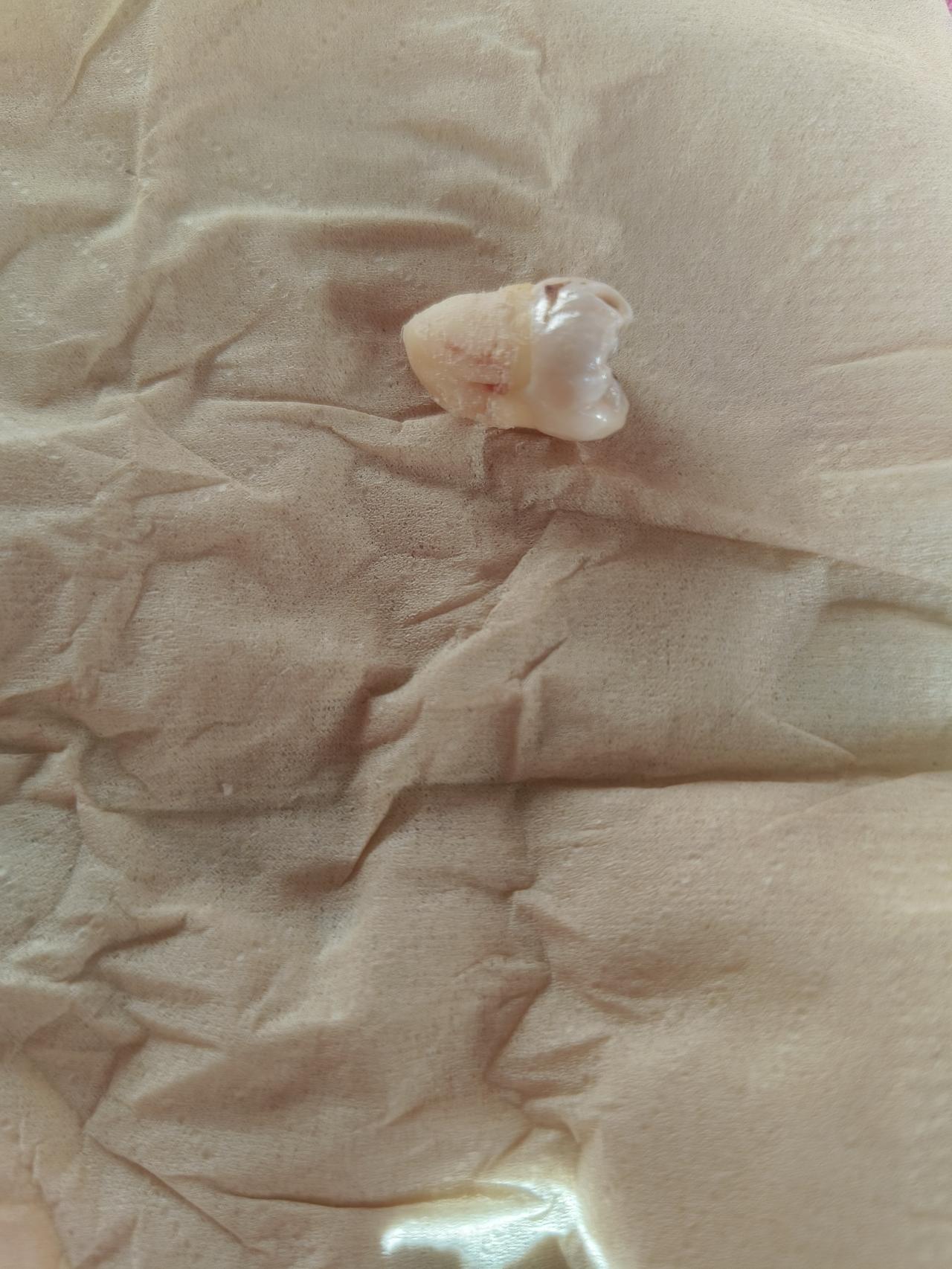 我有两个智齿，不知道需不需要拔掉如果没有长歪，智齿不需要拔，如果长歪了磨脸，或是