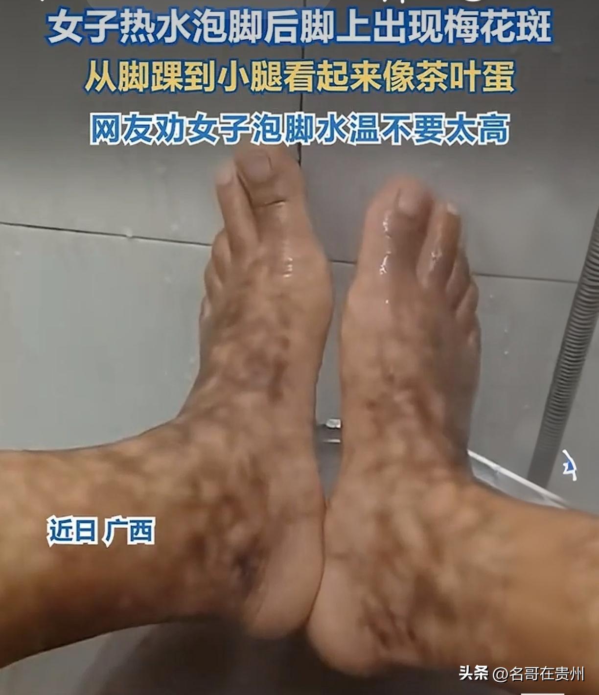 女子泡脚烫出“梅花斑”！求医还是求救？养生杀手就在身边！

广西一女子最近摊上大