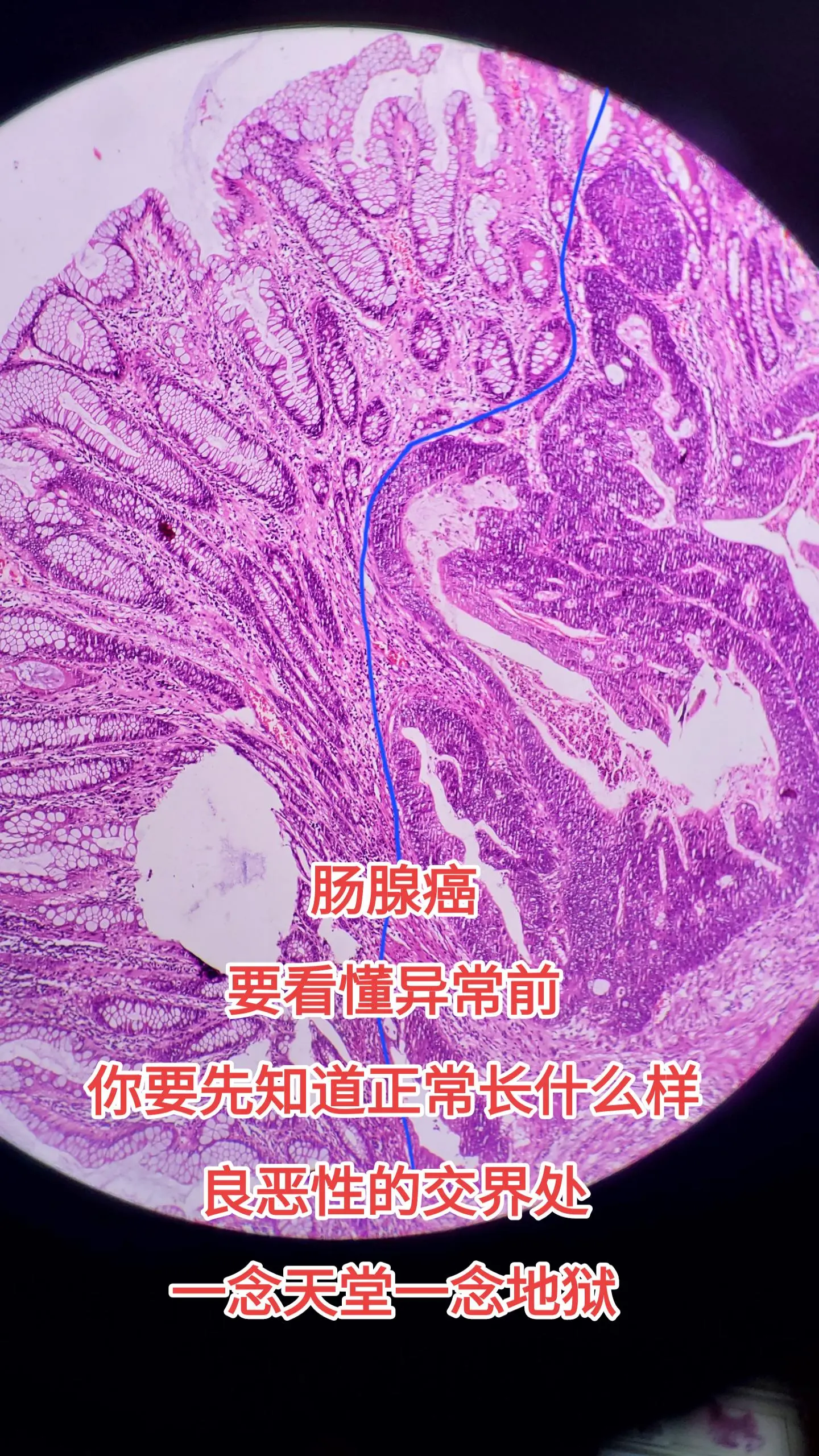 结肠腺癌