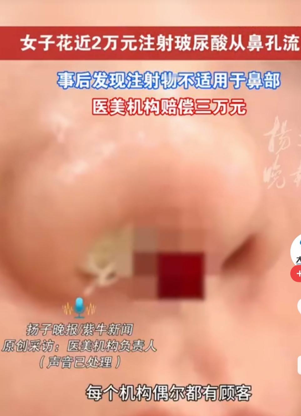 女子花了大价钱去整容鼻子，希望自己变美。可是她的鼻子被注射了玻尿酸之后，后来就红