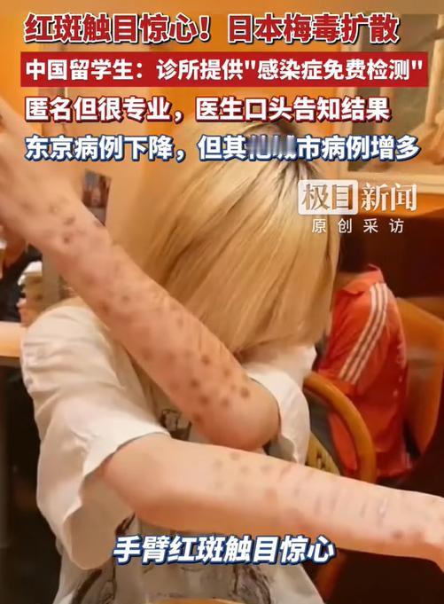 看到日本有些年轻人，在网上分享自己得了梅毒，甚至还配上可爱的表情，像在说一件普通