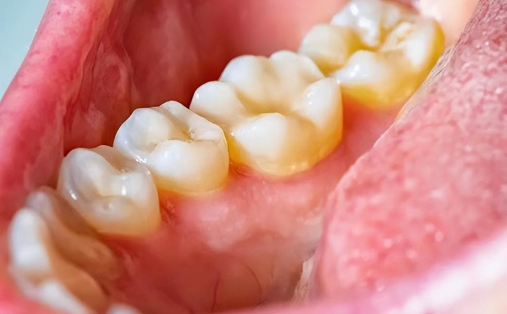 牙缝里的牙结石，怎么清除干净？医生：教你3个方法，轻松除牙垢

牙缝里藏着牙结石